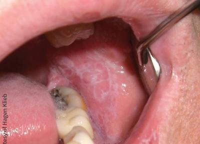 لیکن پلان دهان چرا ایجاد می گردد و چطور درمان می گردد؟