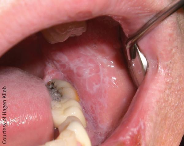 لیکن پلان دهان چرا ایجاد می گردد و چطور درمان می گردد؟